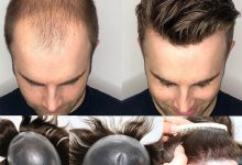 Mens Hair Systems